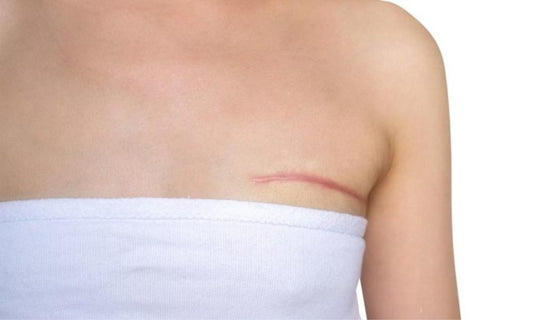 What to expect after a mastectomy, and some home remedies to help the healing processes