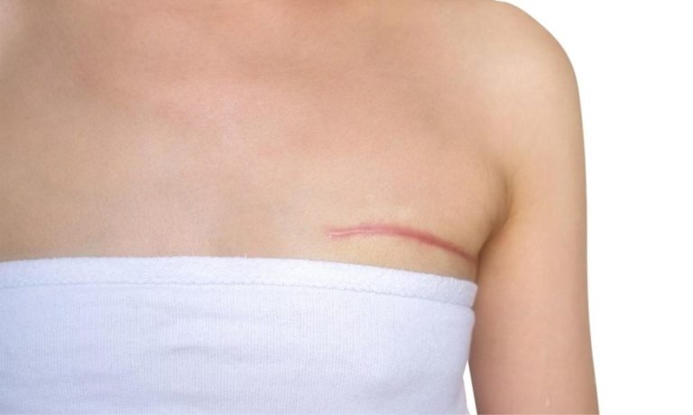 What to expect after a mastectomy, and some home remedies to help the healing processes