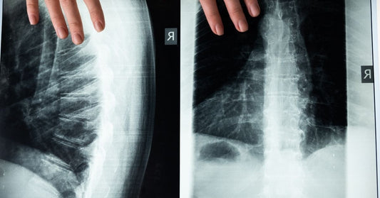 7 non-surgical treatments and 7 hot and cold packs uses as remedies for herniated or slipped discs